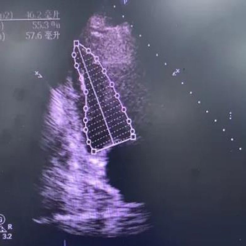 病例分享丨琥珀酰明胶注射液在冠状动脉旁路移植术中的应用