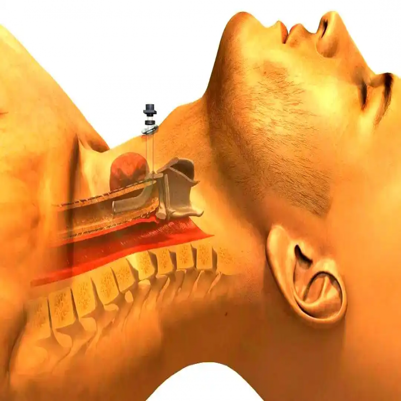 病例讨论︱术中气管导管脱出1例