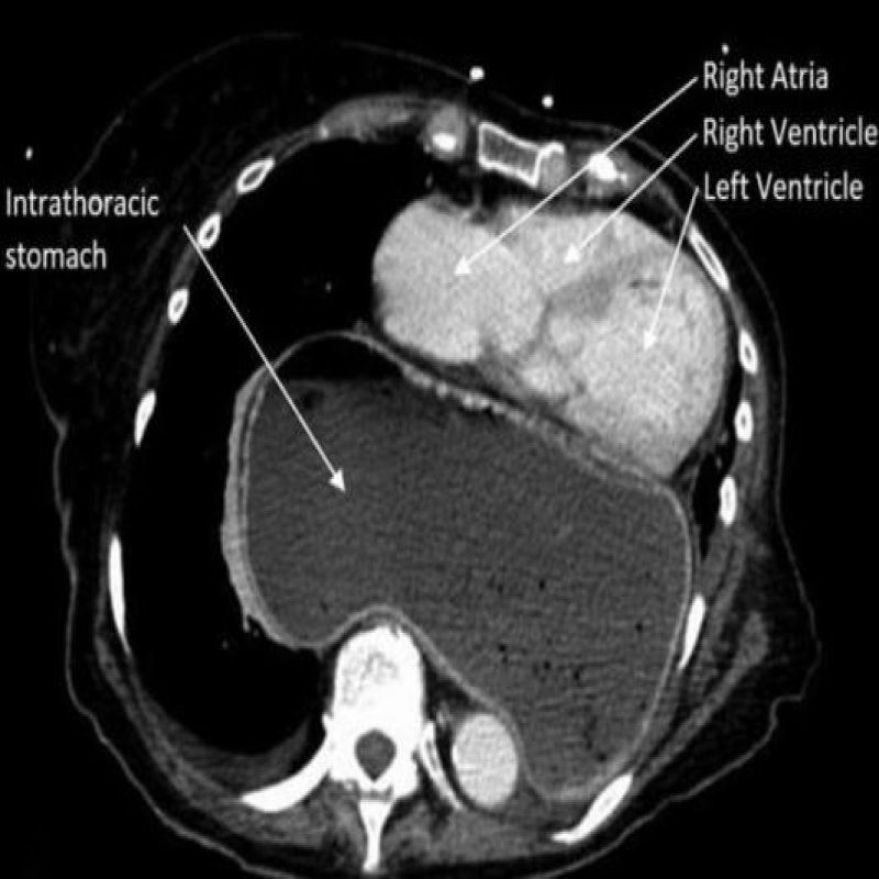 山东ERAS论坛 | 巨大食管裂孔疝的胸腔内压迫：围术期管理的警示与对策