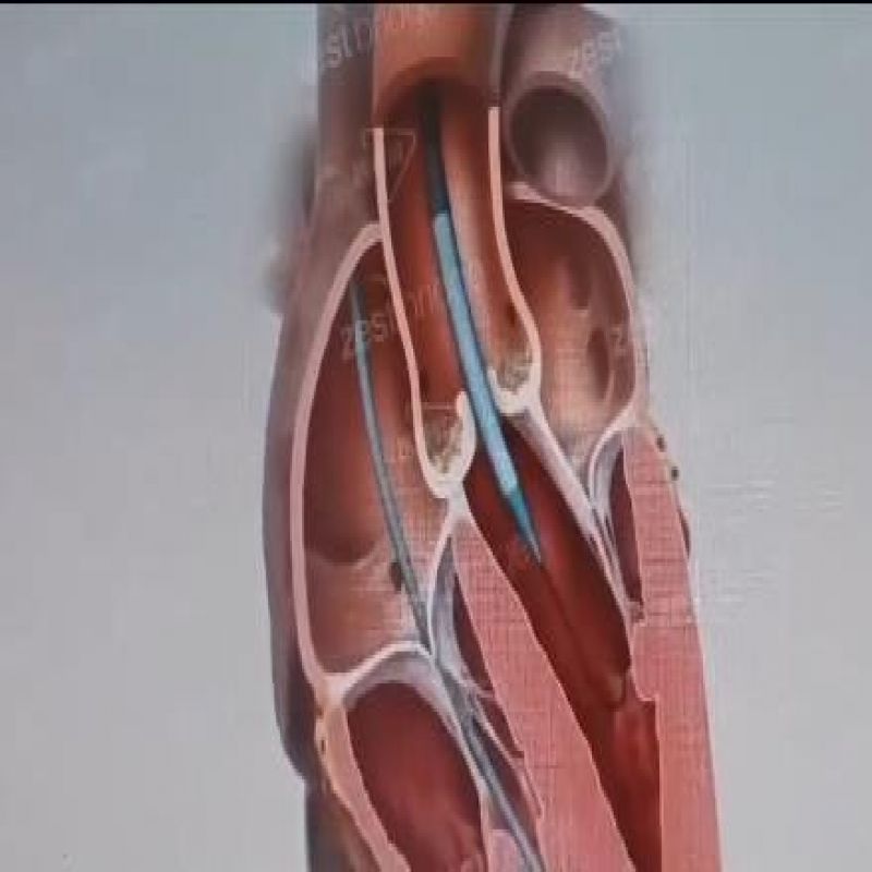 重度主动脉瓣狭窄合并肾功能衰竭行TAVR手术麻醉分享